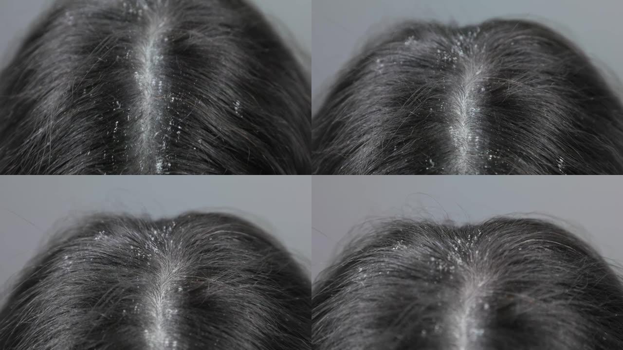 头皮疾病的概念。头皮屑特写的肮脏黑发。顶视图。沿着头发分开的运动