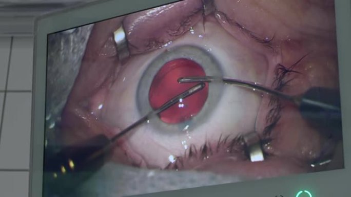 手术室手术设备监视器屏幕上的眼部手术特写视图