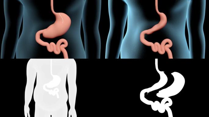 Xray Man的袖状胃切除术