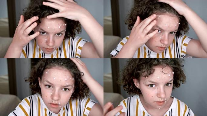 十几岁的女孩用某种奶油润滑痤疮。自我药物治疗的危险