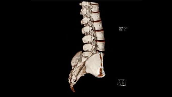 腰骶部脊柱的计算机断层扫描体积绘制检查