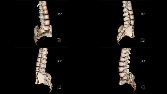 腰骶部脊柱的计算机断层扫描体积绘制检查