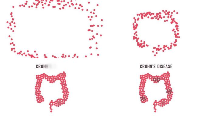 克罗恩病丸动画形成肠