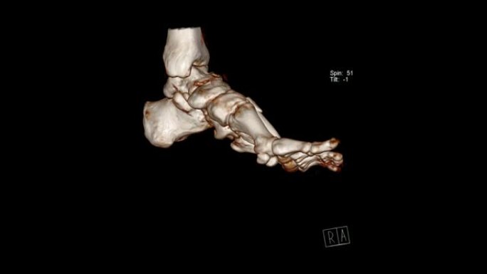 足部计算机断层扫描体积渲染检查
