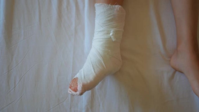 一个小女孩腿上有一个石膏。用绷带包扎儿童的脚踝
