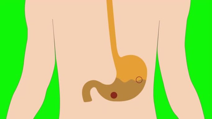 人胃酸的动画，胃酸反流