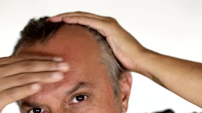 男人检查脱发-后退的发际线