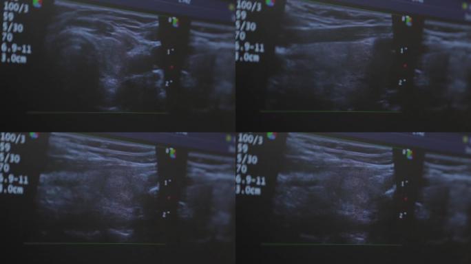 医疗中心的超声波设备。屏幕图像