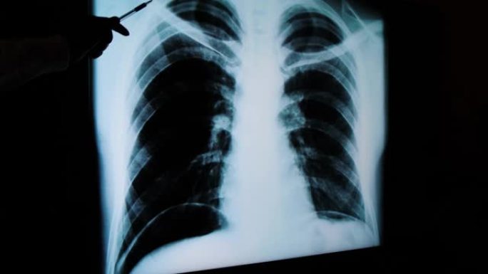 医生的手显示了肺部的x光。屏幕上的肺肺炎