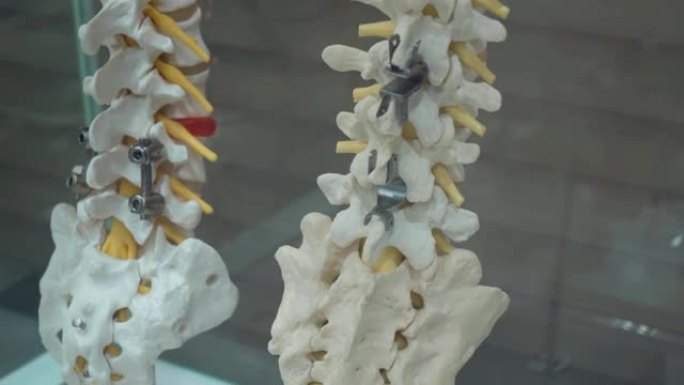 带有金属假肢的人体脊柱假肢示例