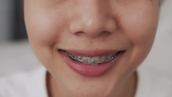 一位年轻微笑的亚洲妇女的脸，牙齿上有牙套，正畸治疗。