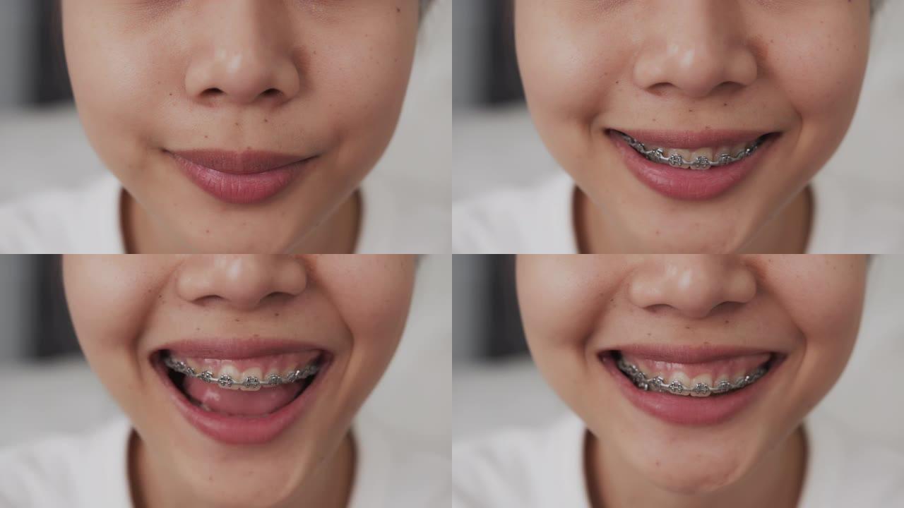 一位年轻微笑的亚洲妇女的脸，牙齿上有牙套，正畸治疗。