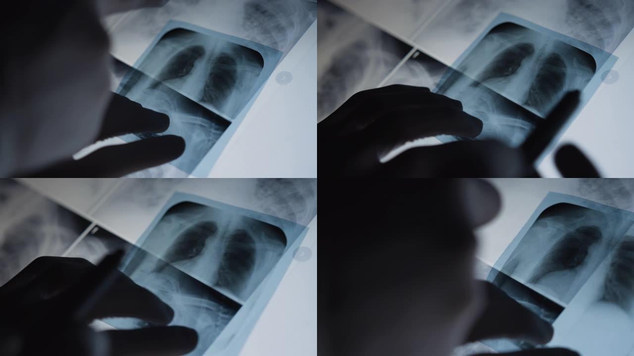 医生检查一名女性患者的肺部x光检查发现了问题。