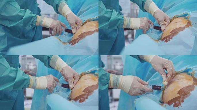 干细胞注射。医生给病人体内注射血液。专家的手戴着注射器的手套。特写。