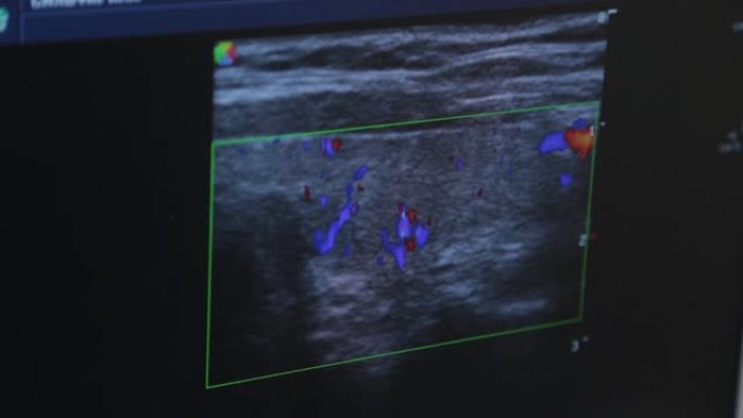 医疗中心的超声波设备。屏幕图像