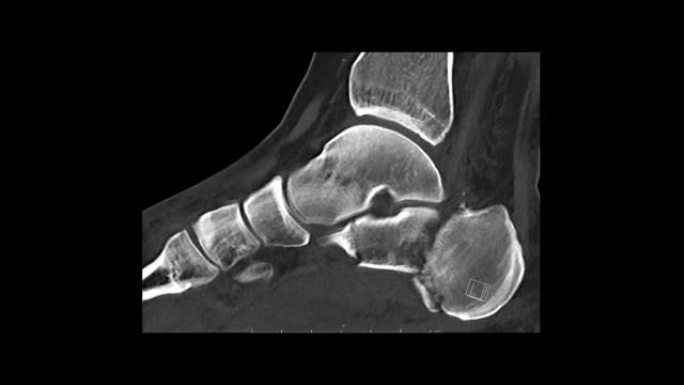 足部矢状面的计算机断层扫描显示跟骨/跟骨骨折 (CT足部)。