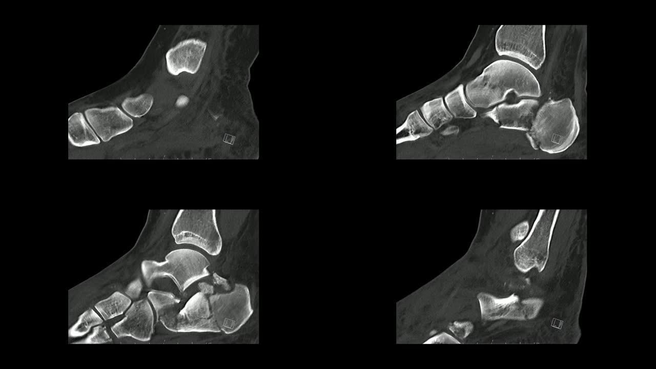 足部矢状面的计算机断层扫描显示跟骨/跟骨骨折 (CT足部)。