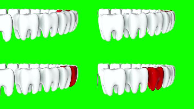 一排白色牙齿中的红牙。3D渲染。牙科，出众，经营理念。