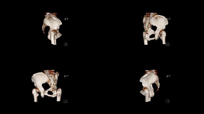 计算机断层扫描体积绘制检查骨盆骨 (CT VR骨盆骨)