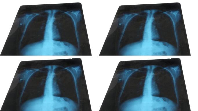 白色背景上肺部的x光照片。新型冠状病毒肺炎冠状病毒肺炎的检测试验。医生检查