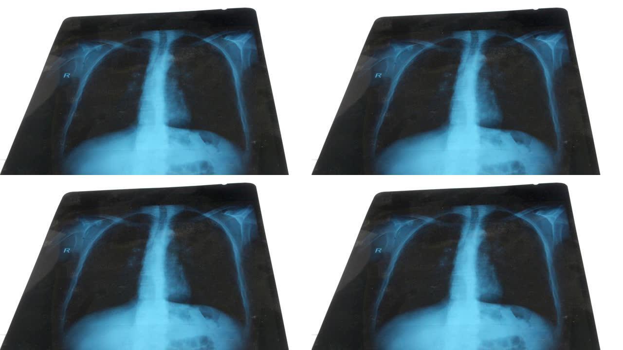 白色背景上肺部的x光照片。新型冠状病毒肺炎冠状病毒肺炎的检测试验。医生检查