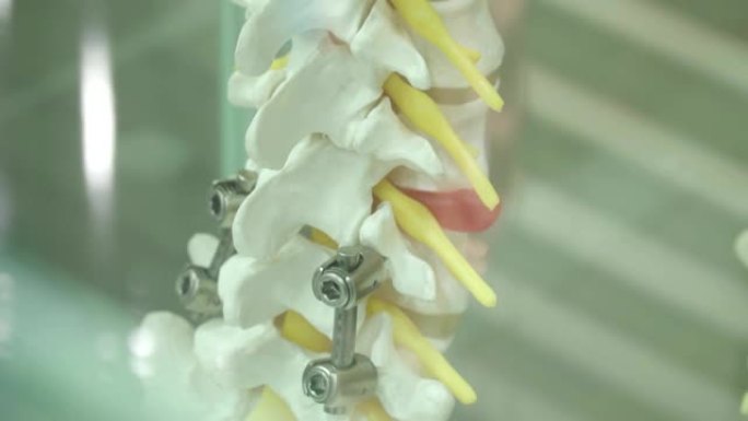 带有金属假肢的人体脊柱假肢示例