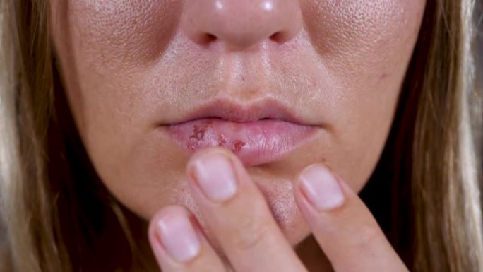 唇疱疹病毒感染会影响女性的嘴唇