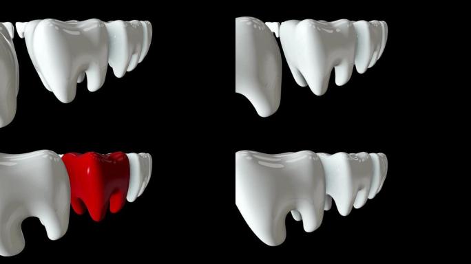一排白色牙齿中的红牙。3D渲染。牙科，出众，经营理念。