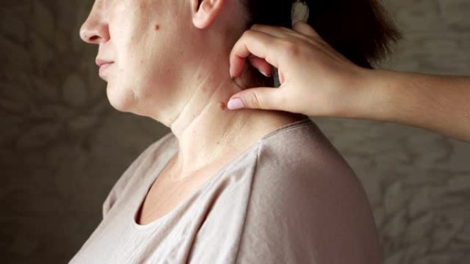 皮肤科医生检查女性脖子上的痣