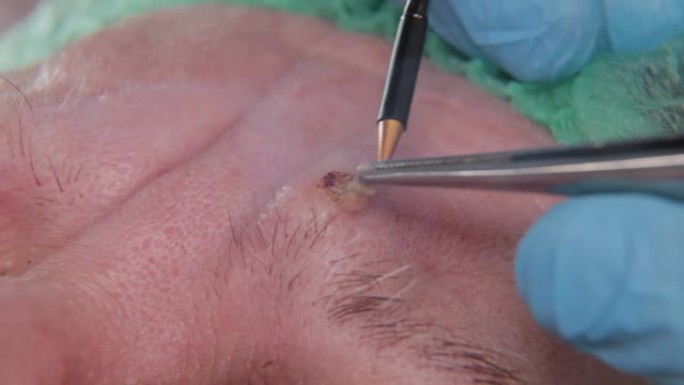 男医生用电刀切除一名老年妇女的乳头状瘤