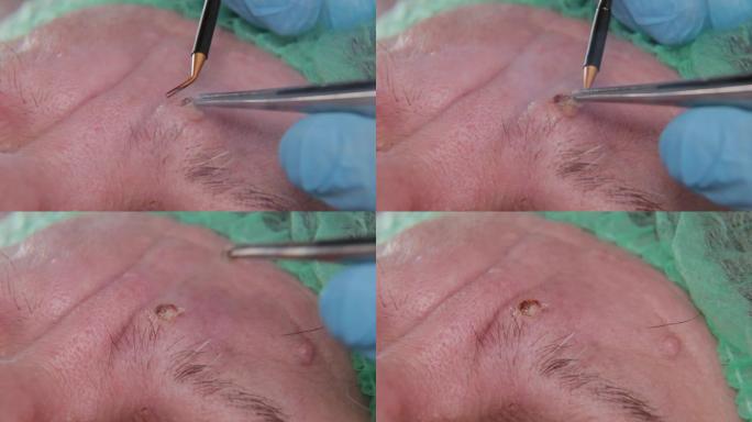 男医生用电刀切除一名老年妇女的乳头状瘤