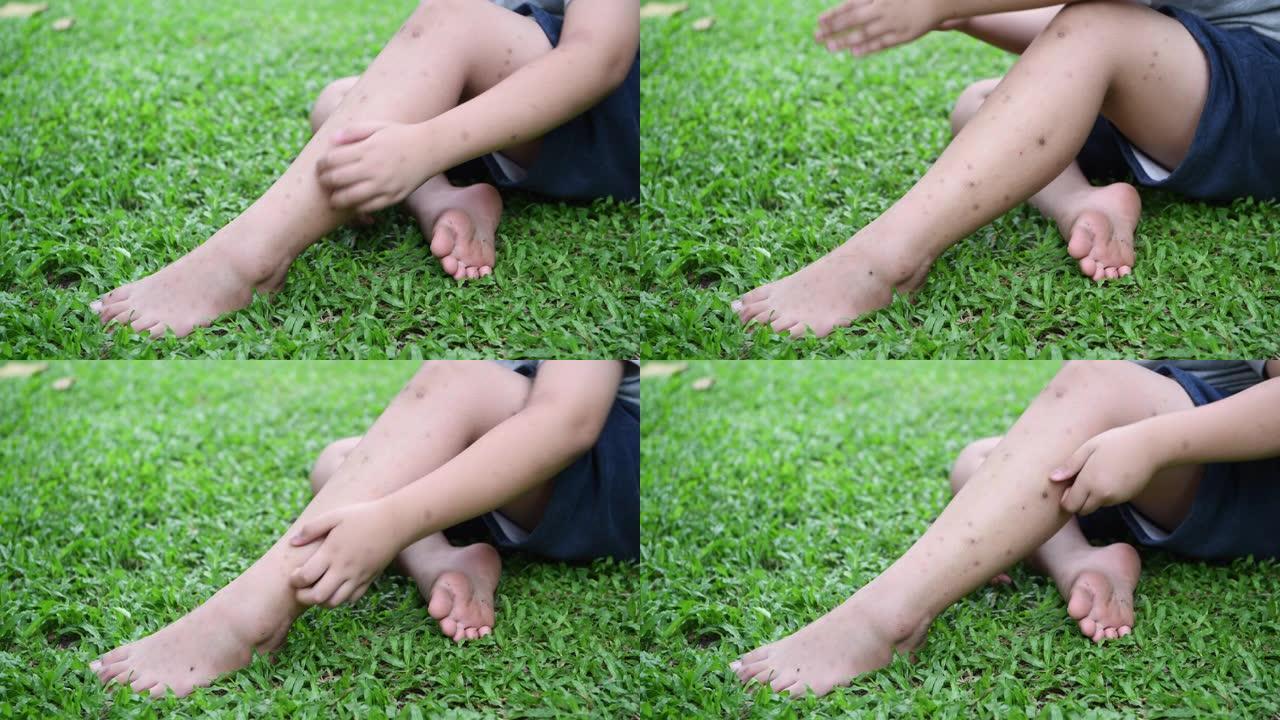 孩子被蚊子叮咬后挠腿，坐在绿草地上。