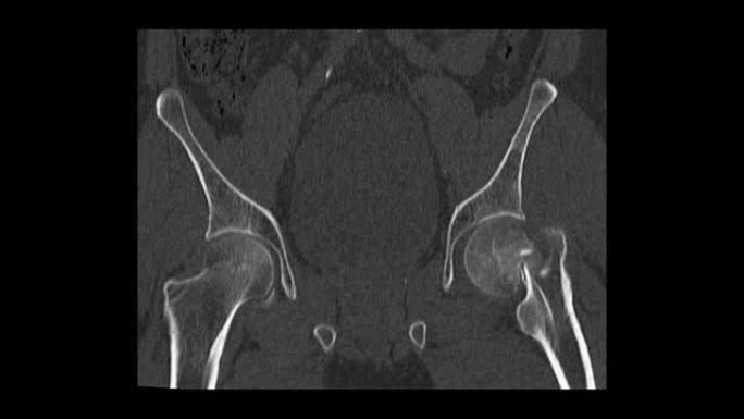 冠状面的骨盆计算机断层扫描显示左股骨颈骨折 (CT骨盆)