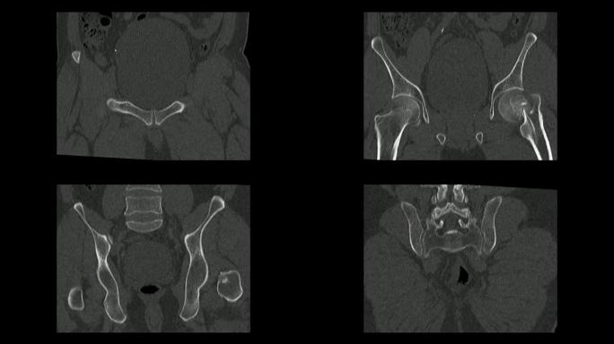 冠状面的骨盆计算机断层扫描显示左股骨颈骨折 (CT骨盆)