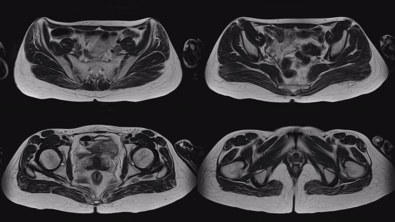 女性盆腔、腹腔、胃肠道及膀胱的MRI
