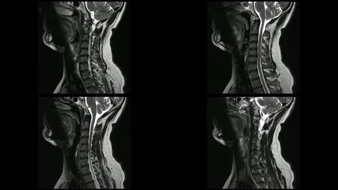 电影模式下颈椎矢状T2-weighted图像的磁共振图像 (MRI颈椎)