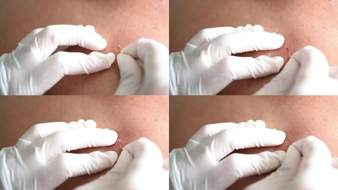 泰国传统医学专家通过使用刺去除异物的纤维来治疗眼睛中的白内障。