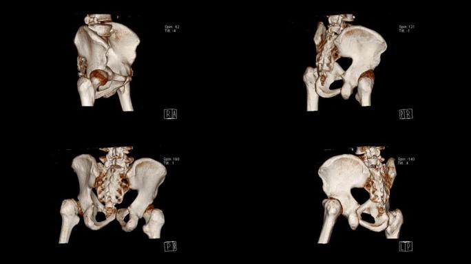 骨盆的计算机断层扫描体积绘制检查显示左股骨颈骨折 (CT VR骨盆)。