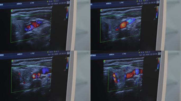 医疗中心的超声波设备。屏幕图像