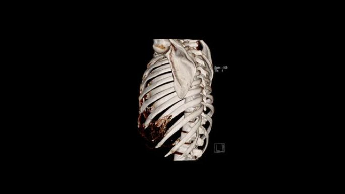 计算机断层扫描胸廓体绘制检查 (CT VR胸廓)。