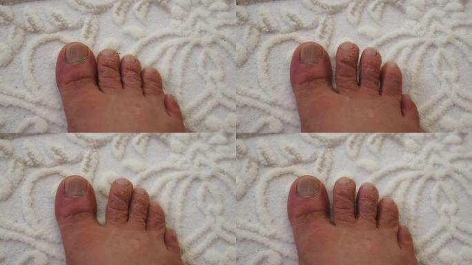 脚趾上形成的老茧，手指老茧，