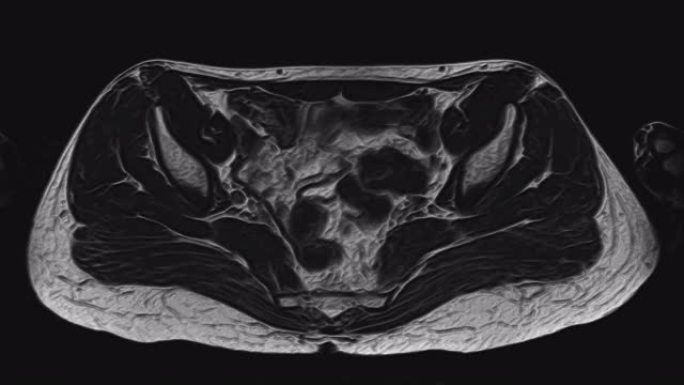女性盆腔、腹腔、胃肠道及膀胱的MRI