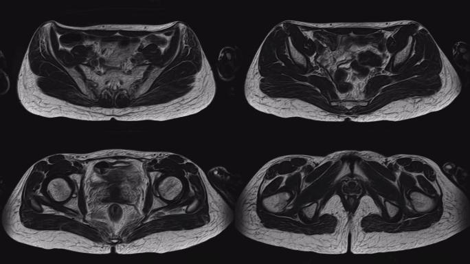 女性盆腔、腹腔、胃肠道及膀胱的MRI