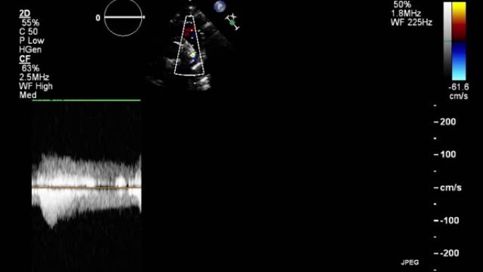 高质量视频超声经食管心脏检查。