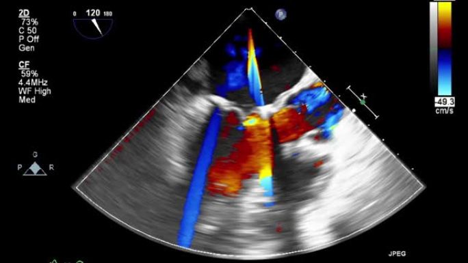 高质量视频超声经食管心脏检查。