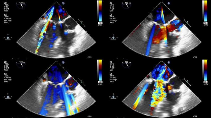 高质量视频超声经食管心脏检查。