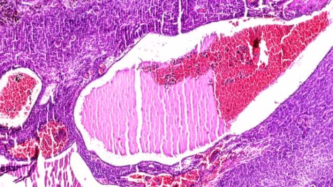 显微镜下的生物纤维肉瘤