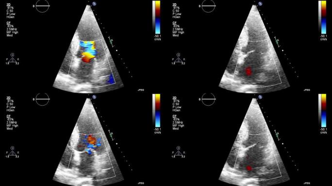 高质量视频超声经食管心脏检查。