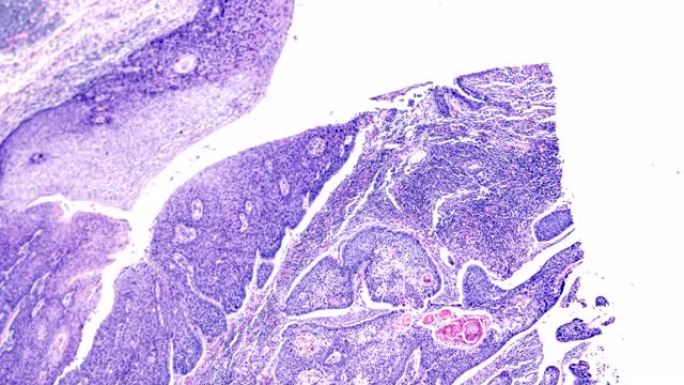 显微镜下鳞状细胞癌