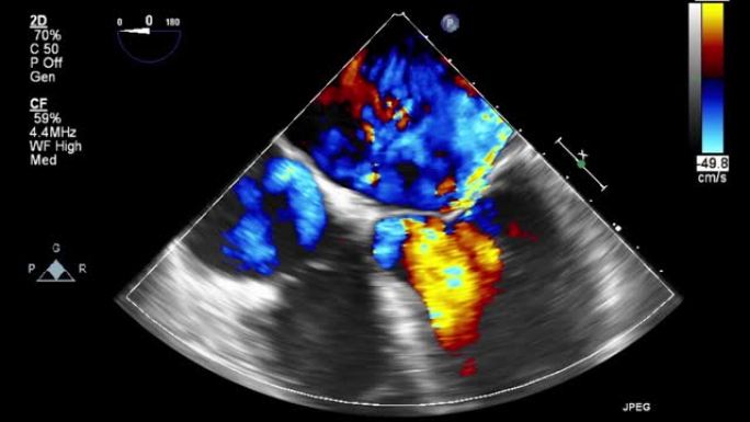 高质量视频超声经食管心脏检查。